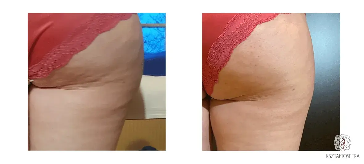 Endermologia: Redukcja cellulitu i modelowanie sylwetki czy to dla Ciebie?