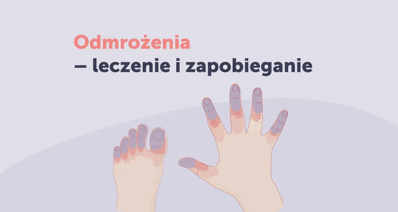 Dłonie i stopy z sinawo-fioletowymi palcami, ilustrujące różne rodzaje odmrożeń.