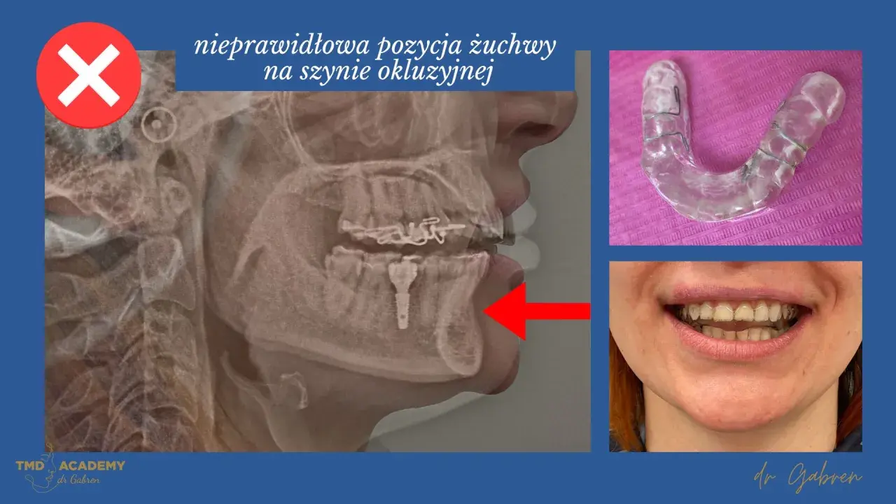 Rentgen żuchwy pokazuje nieprawidłową pozycję na szynie okluzyjnej. Szynoterapia pomaga poprawić zgryz.