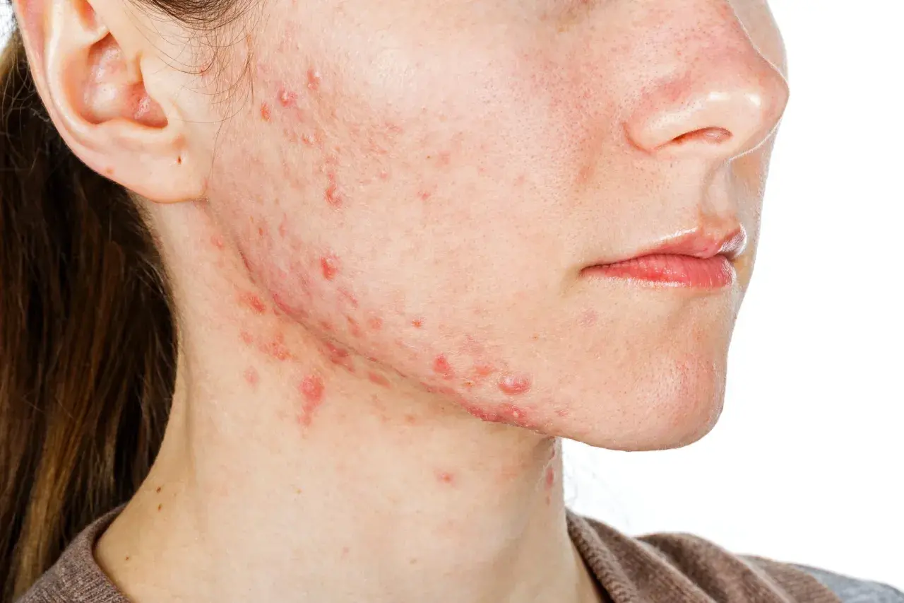 Visage avec acné légère sur la joue et le cou, une peau qui pourrait bénéficier de Roaccutane.