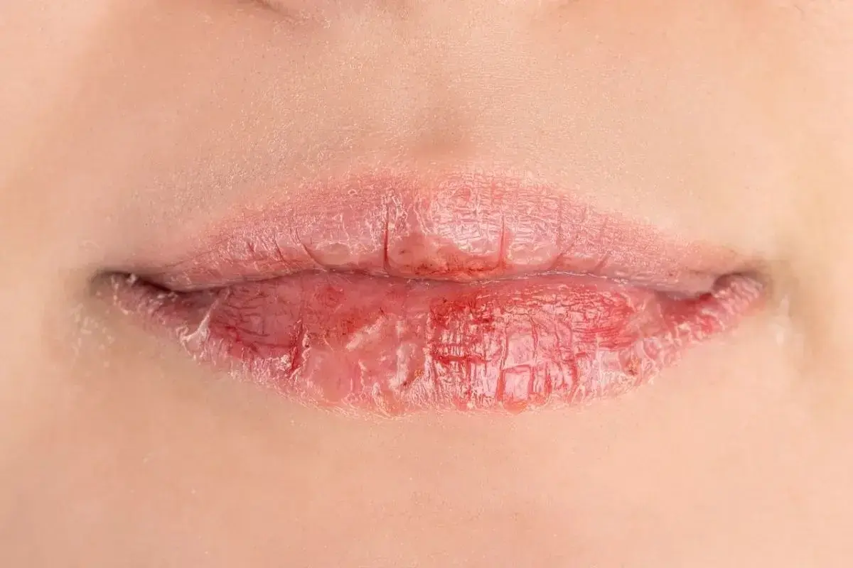 Labbra secche e screpolate, con pelle che si sfalda. Le cause possono essere molteplici, dal freddo alla disidratazione.