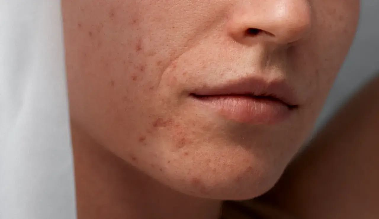 Gros plan sur le visage d'une femme montrant des imperfections et des rougeurs, typiques de l'acné de fin de grossesse.