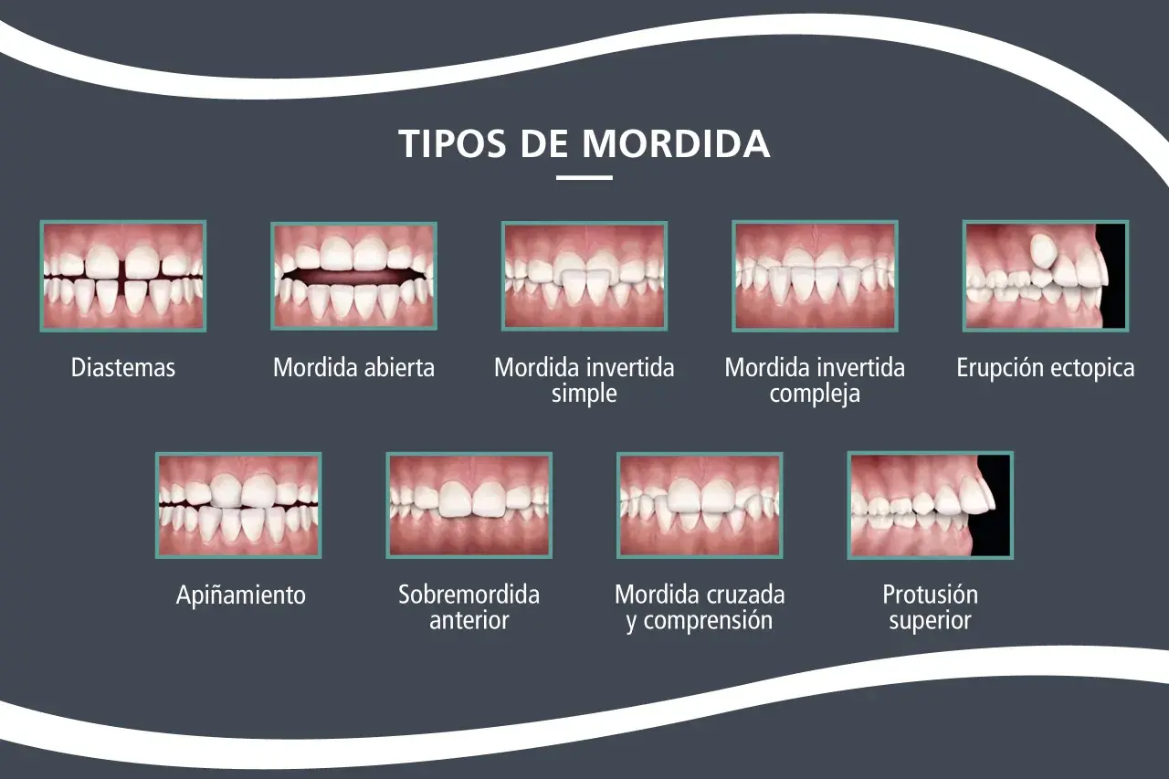 Ilustración de varios tipos de mordida dental, incluyendo una **mordida abierta** donde los dientes frontales no se tocan al cerrar la boca.