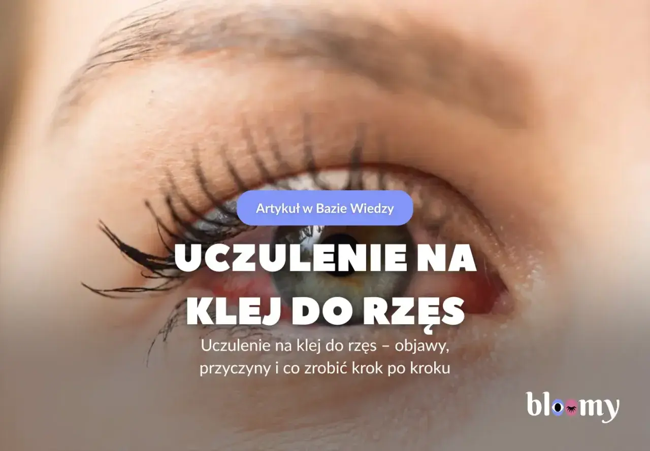 Czerwone, podrażnione oko z widocznym uczuleniem na klej do rzęs. Artykuł omawia objawy i przyczyny.