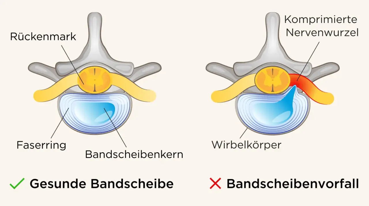 Vergleich einer gesunden Bandscheibe mit einem Bandscheibenvorfall, der eine Nervenwurzel komprimiert und so Symptome verursacht.