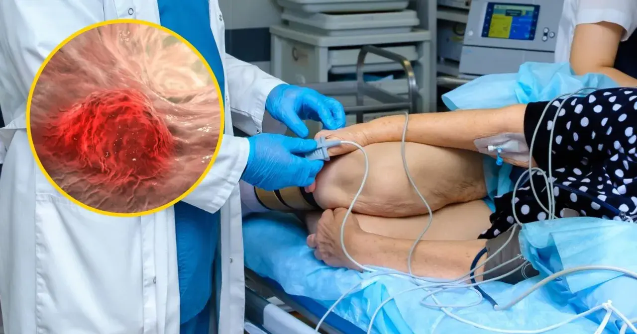 Lekarz w rękawiczkach przygotowuje pacjenta do zabiegu, podczas gdy powiększony obraz pokazuje komórki raka jelita grubego.