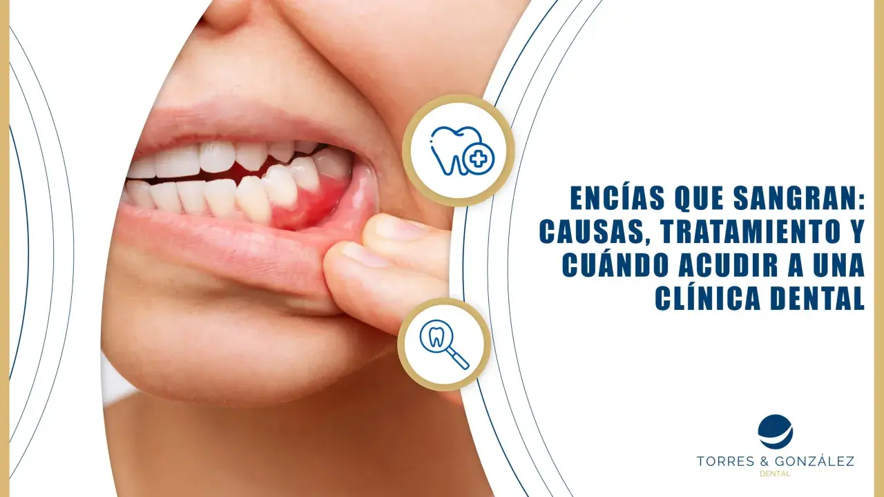 Primer plano de encías inflamadas y enrojecidas, indicando la posibilidad de encías sangrantes. El texto informa sobre causas y tratamientos.