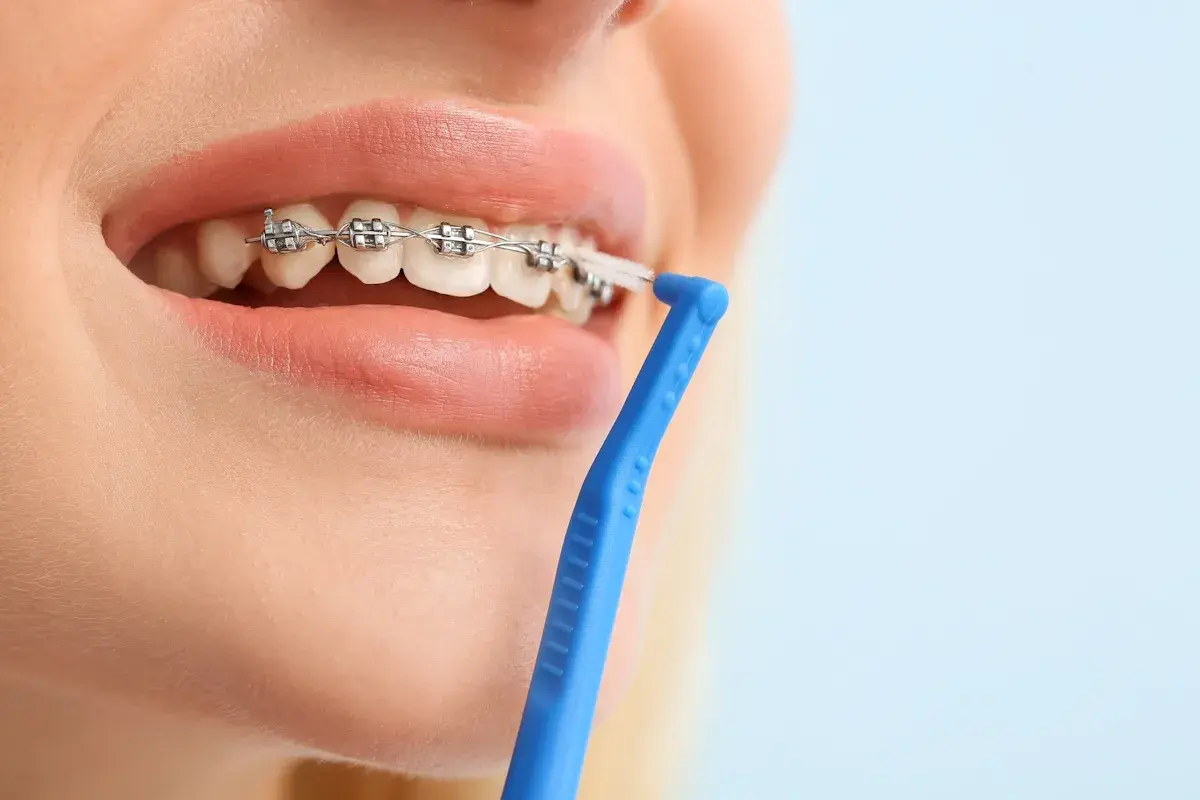 Pulizia dei denti con apparecchio, un passo fondamentale per prevenire l'alitosi. Rimedi efficaci per un sorriso smagliante.