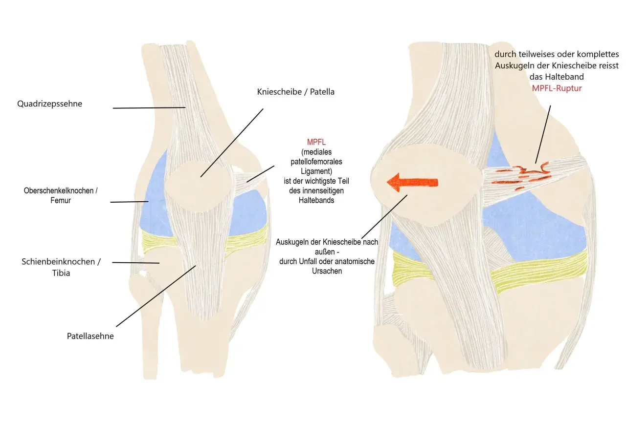 Anatomische Darstellung eines Knies, die zeigt, wie das MPFL-Band bei einer Ausrenkung der Kniescheibe reißen kann (MPFL-Ruptur).