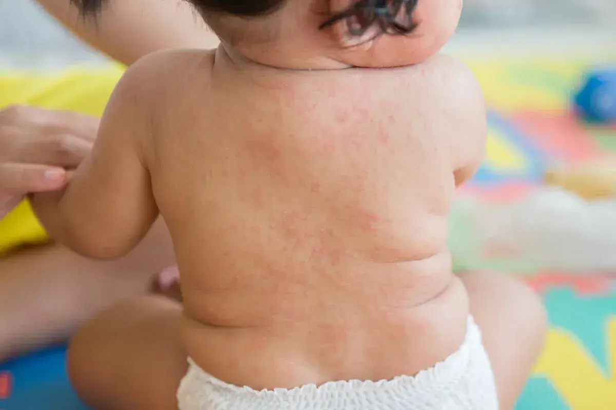 Baby's Rücken zeigt einen roten Ausschlag, möglicherweise nach 3 Tagen Fieber.