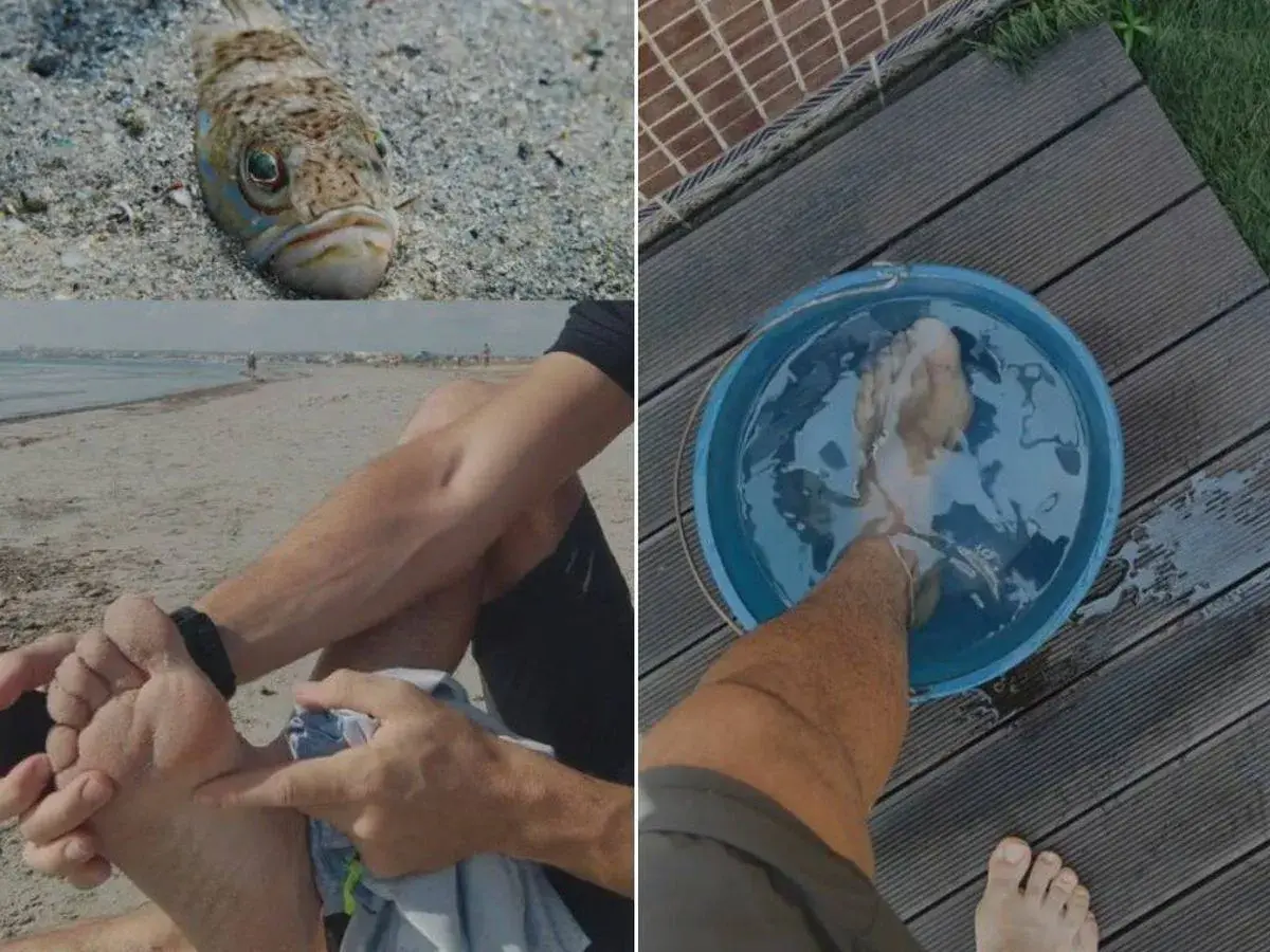 Pez escorpión picadura: pie en agua caliente tras sufrir una picadura en la playa.