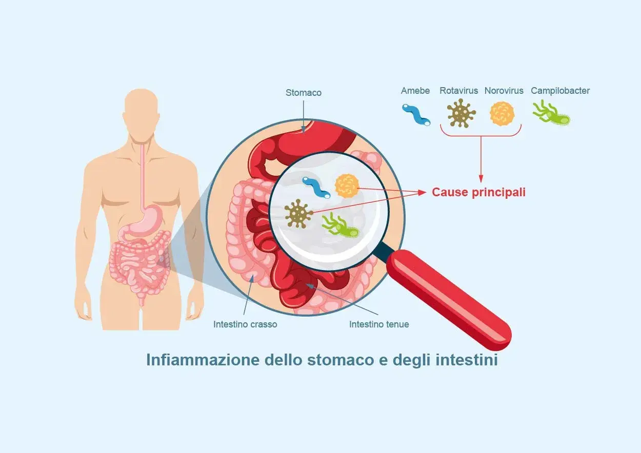 Illustrazione dell'apparato digerente con ingrandimento che mostra i microrganismi causa di gastroenterite sintomi.