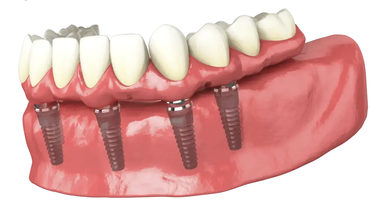 Dettaglio di una protesi dentale fissa su impianti, simile alla protesi Toronto, con denti bianchi e gengive rosa.