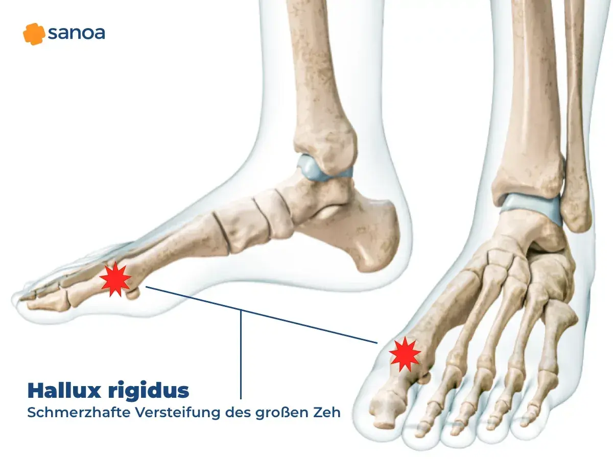 Anatomische Darstellung des Fußskeletts mit Hervorhebung des Gelenks am großen Zeh, das von Hallux rigidus betroffen ist.