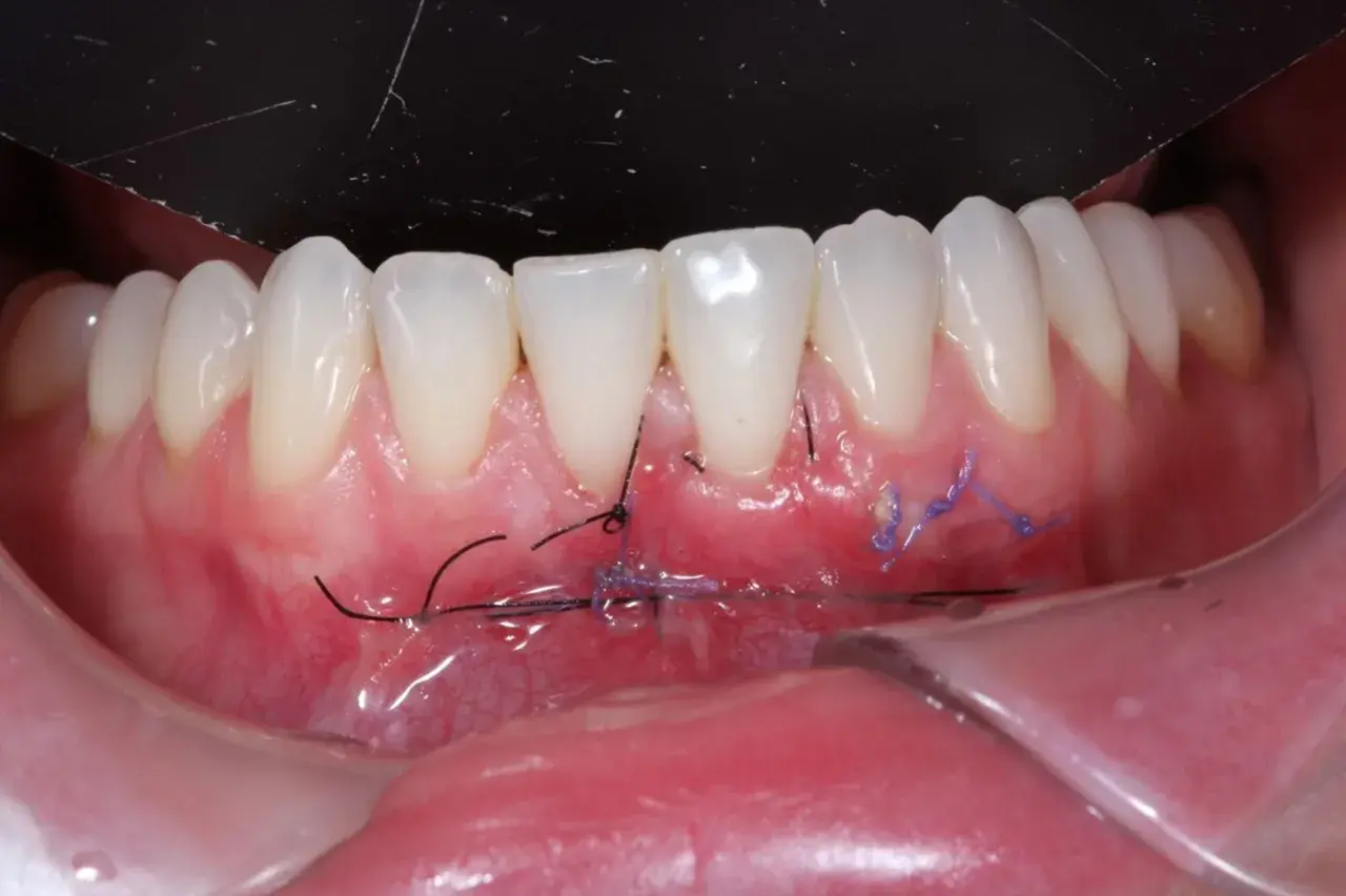Boca con injerto libre de encía y suturas visibles. El tejido gingival se ve enrojecido y con puntos de sutura negros y morados.