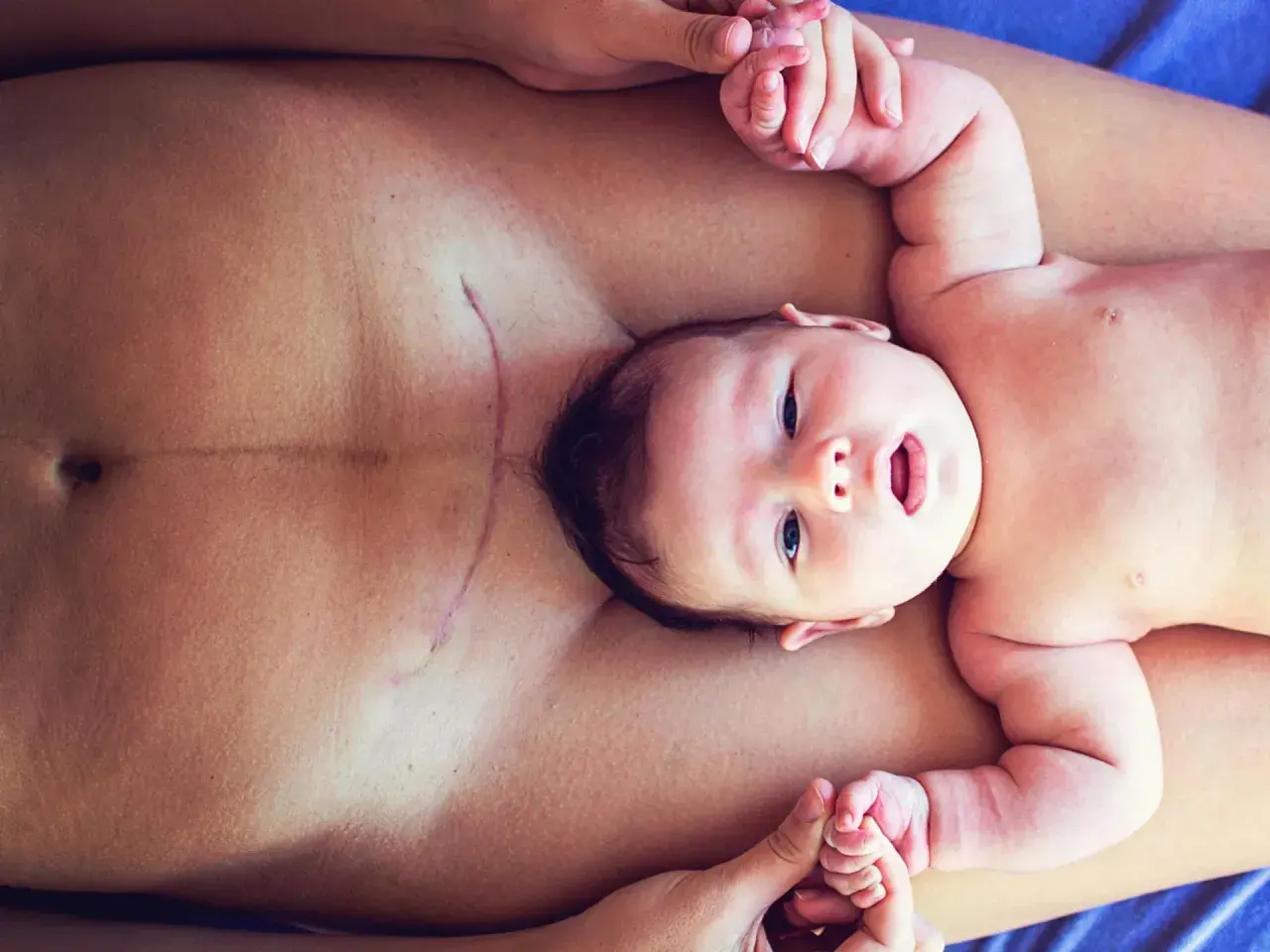 Ein Baby liegt auf dem Bauch seiner Mutter, deren Kaiserschnittnarbe sichtbar ist. Mögliche Symptome eines Geburtstraumas nach Kaiserschnitt können hier thematisiert werden.