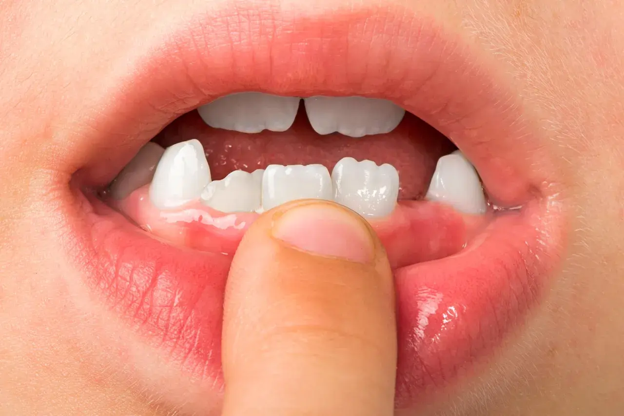 Boca de niño mostrando dientes temporales y un dedo que señala la encía, indicando la etapa en que a que edad se caen los colmillos.