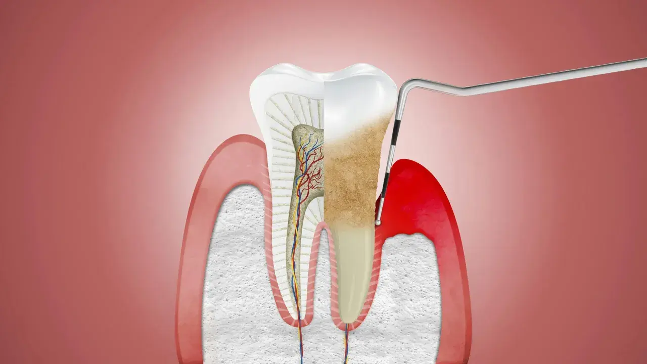 Przekrój zęba z widocznymi naczyniami krwionośnymi i nerwami. Narzędzie dentystyczne usuwa kamień nazębny, odsłaniając zdrowe przyzębie.