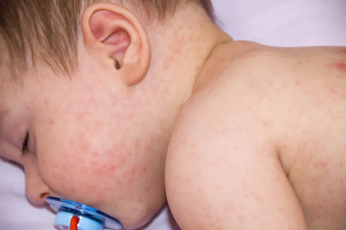 Bebé con sarpullido por fiebre en la cara y el cuello. Pequeñas manchas rojas cubren su piel, indicando una posible enfermedad infantil.