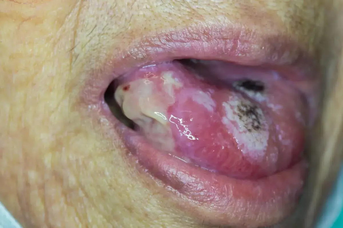 Lingua con lesioni biancastre e aree necrotiche, suggestive di carcinoma squamoso lingua.