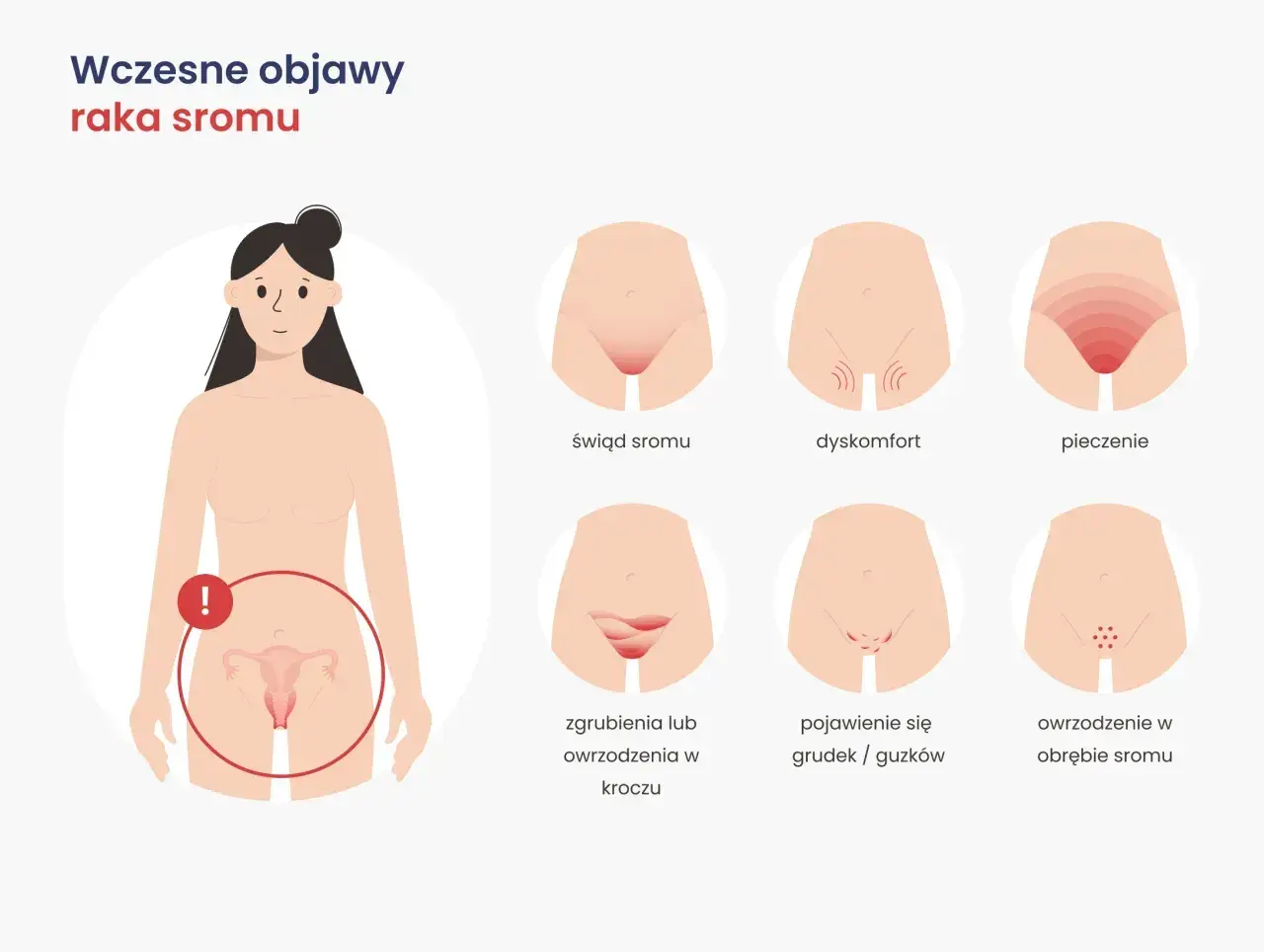 Ilustracja pokazuje wczesne objawy raka sromu: świąd, dyskomfort, pieczenie, zgrubienia, grudki i owrzodzenia.
