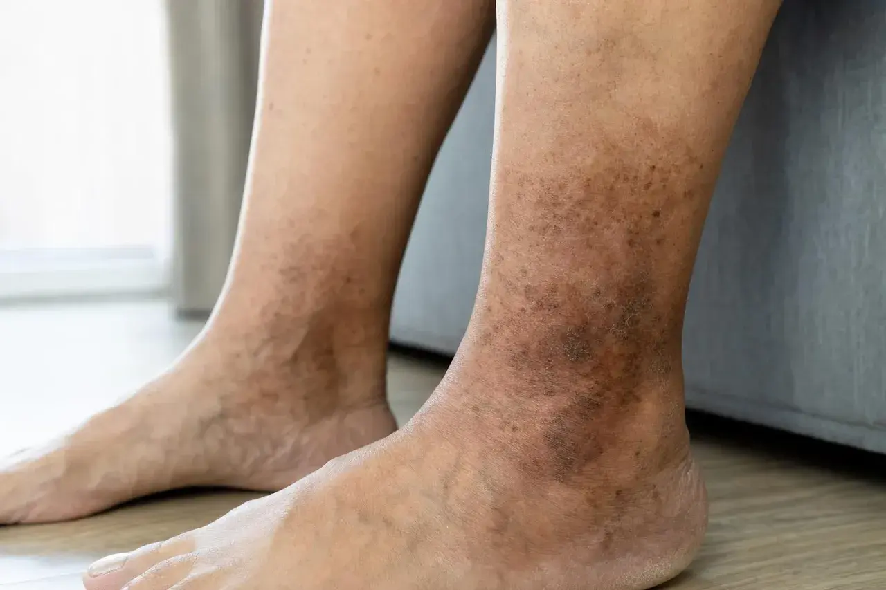 Gambe con macchie scure e arrossate, che suggeriscono prurito agli arti inferiori.