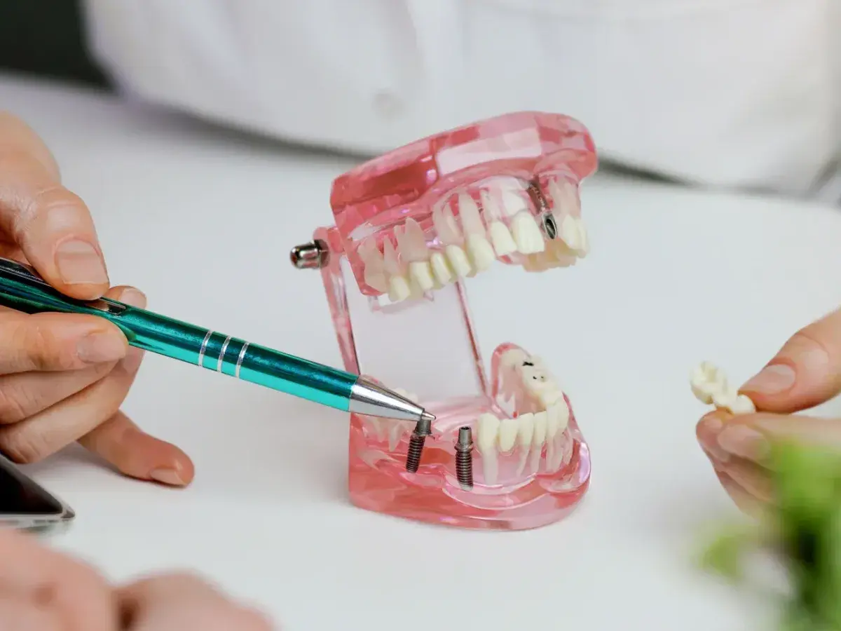 Pokazano model szczęki z implantami. Dyskutujemy, co zamiast implantu, prezentując alternatywne rozwiązania protetyczne.
