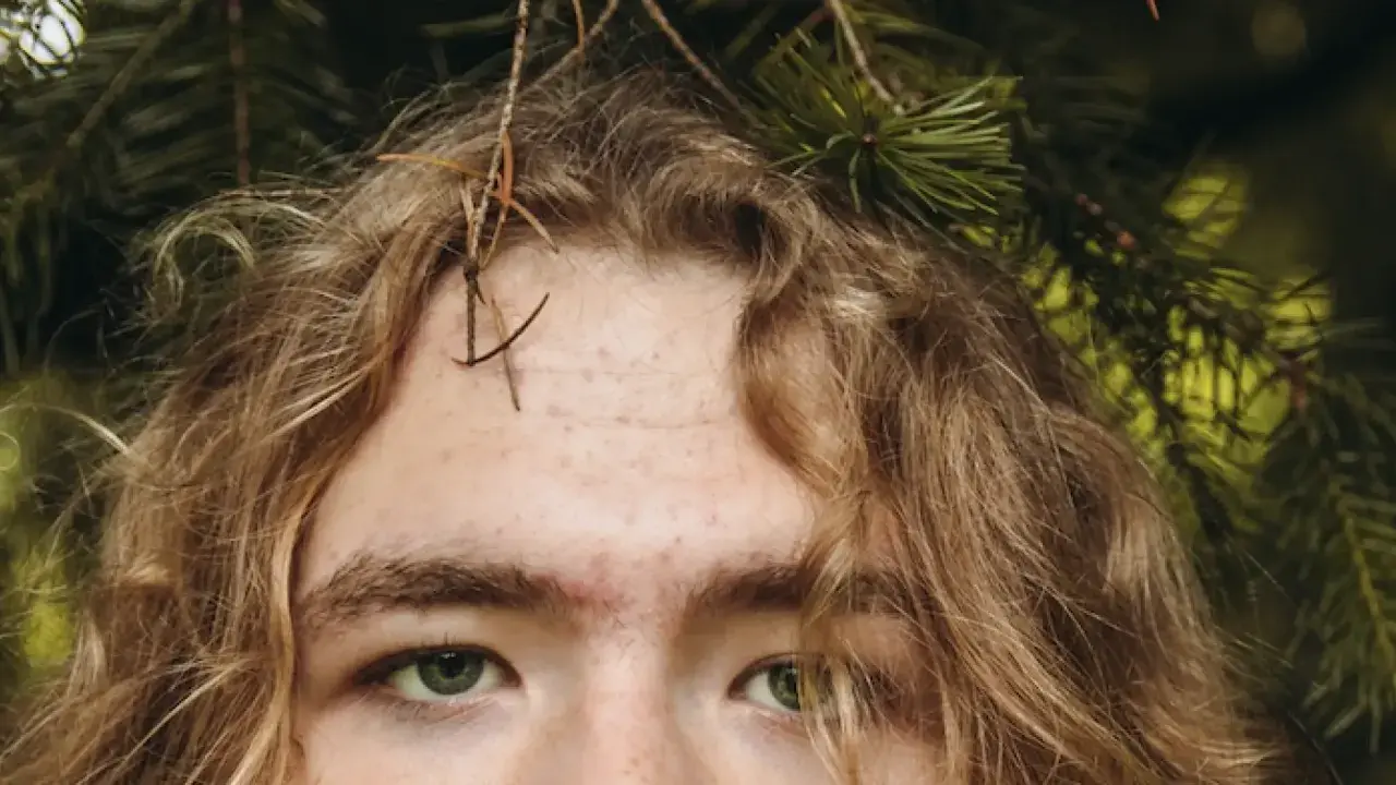 Primer plano de una persona con cabello rubio y ojos verdes, con **acné en la frente** y ramas de pino alrededor.