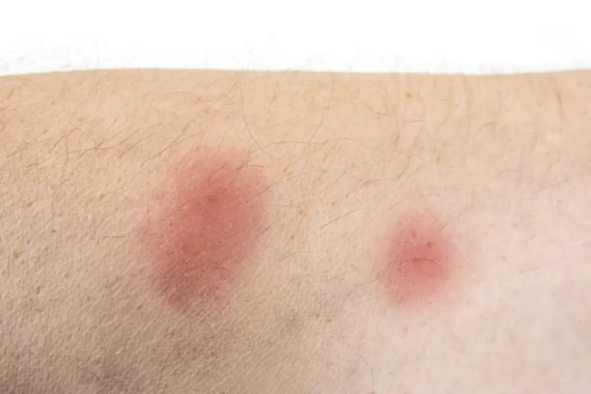 Hausstaubmilben Allergie Symptome: So erkennen Sie die Anzeichen