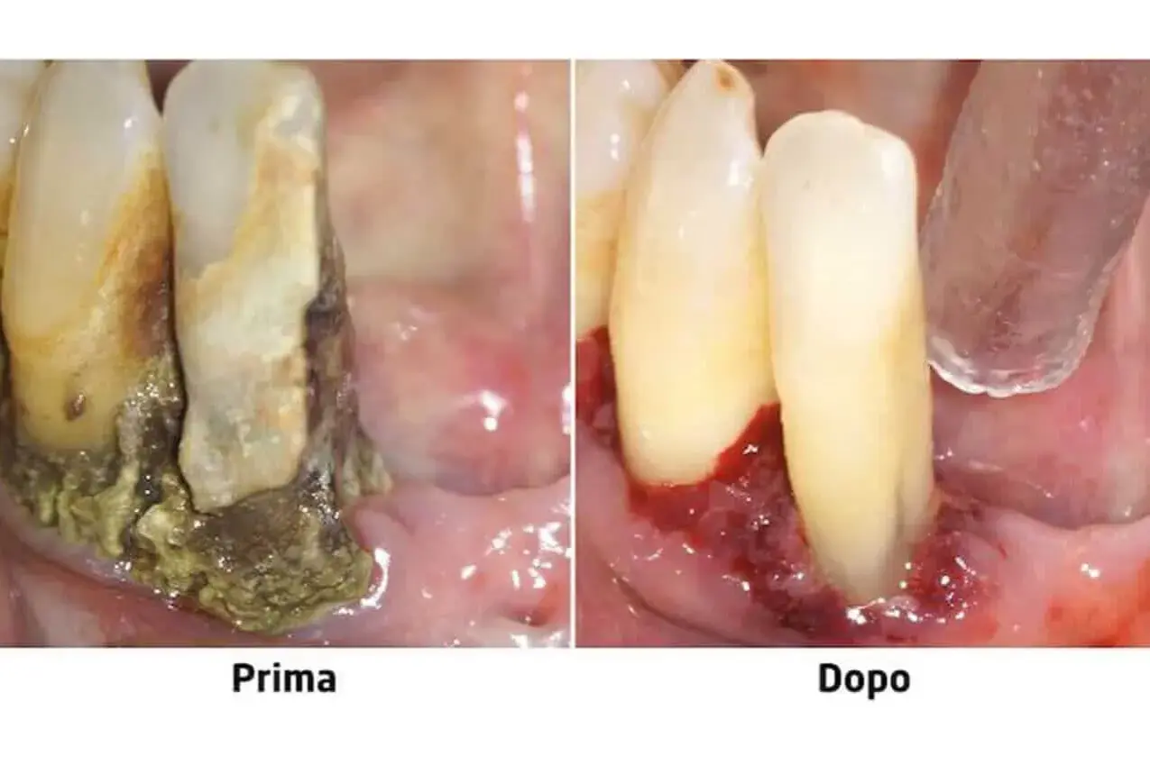 Prima e dopo: gengive infiammate e denti con tartaro, poi gengive sane. La piorrea può portare alla caduta dei denti.