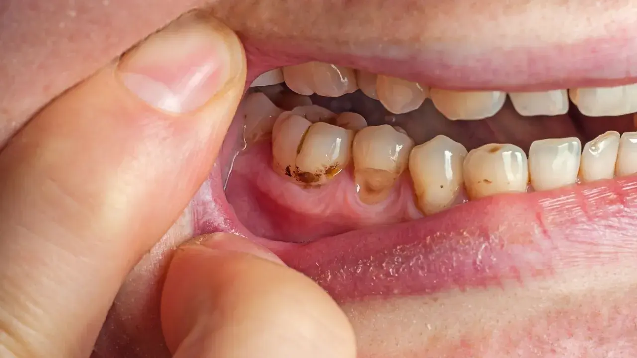 Denti cariati e gengive infiammate, possibili cause di alito cattivo dallo stomaco.