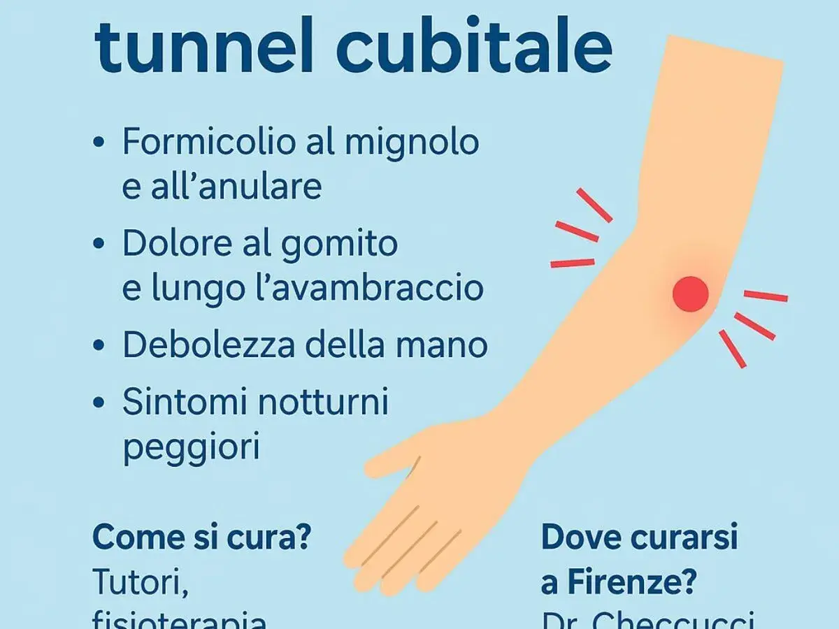 Dolore al gomito e formicolio al mignolo, sintomi del tunnel cubitale dovuti alla compressione del nervo ulnare.