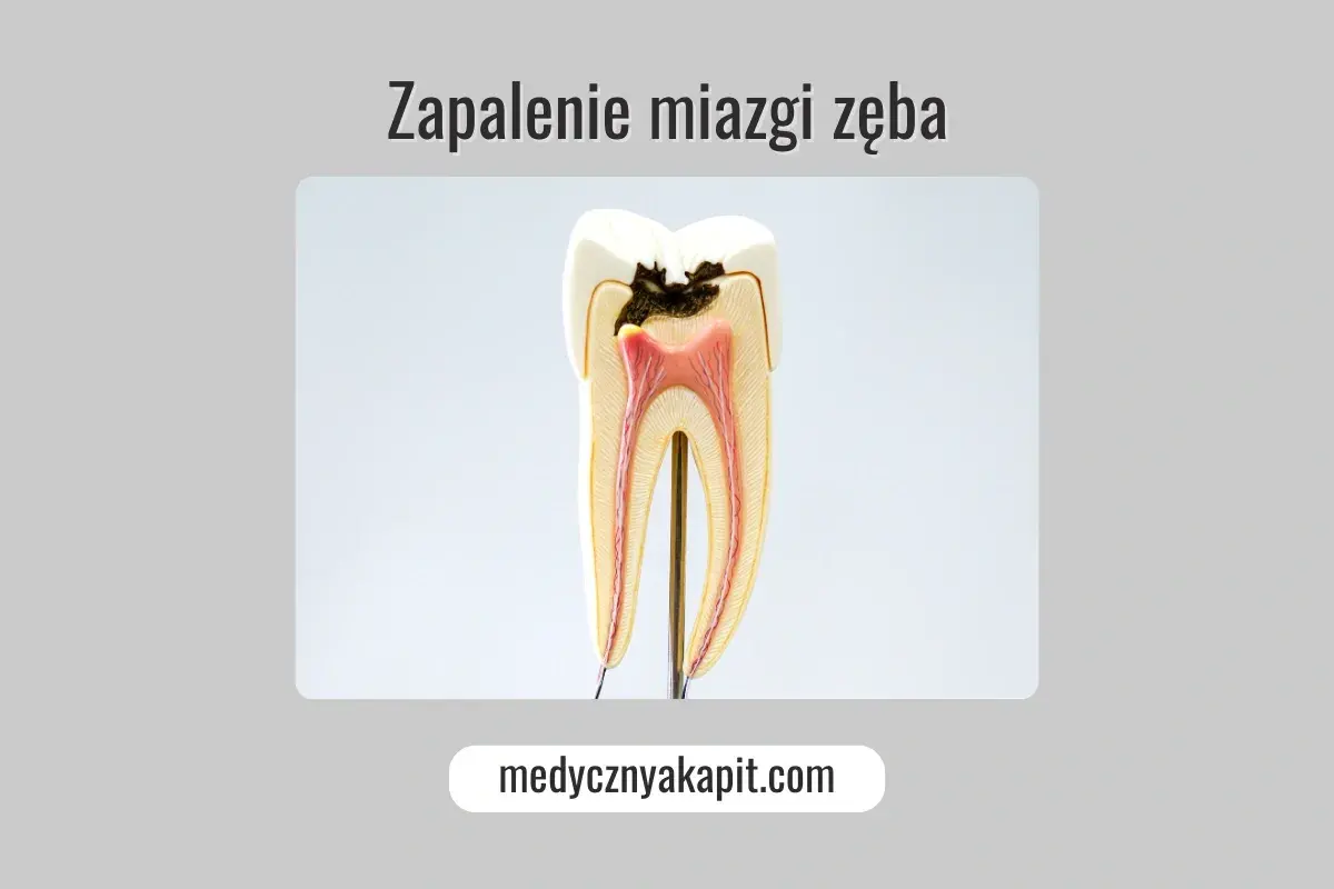 Model zęba ukazujący próchnicę i zapalenie miazgi.