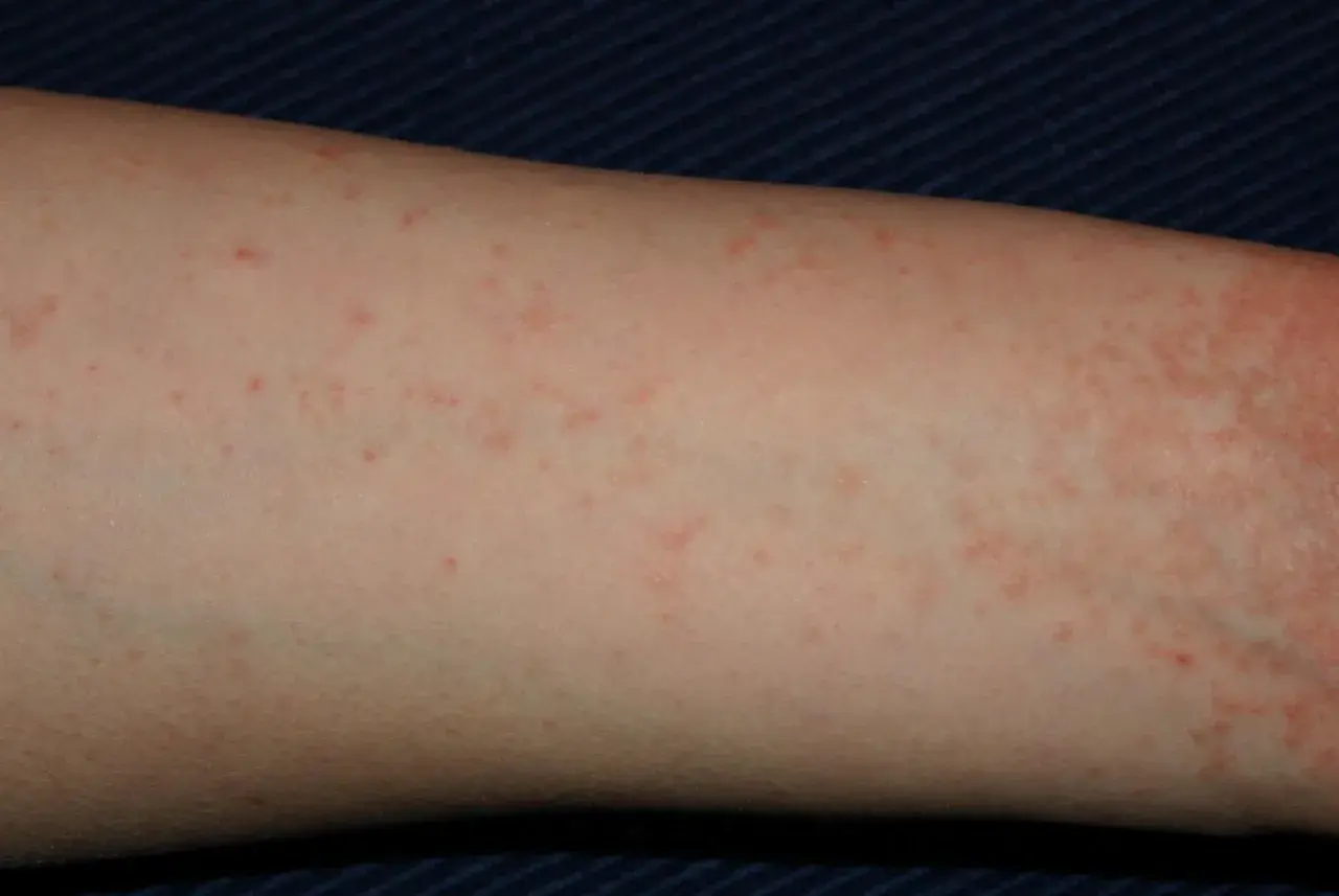 Braccio con eruzione cutanea rossa e pruriginosa, simile a una falsa scabbia.