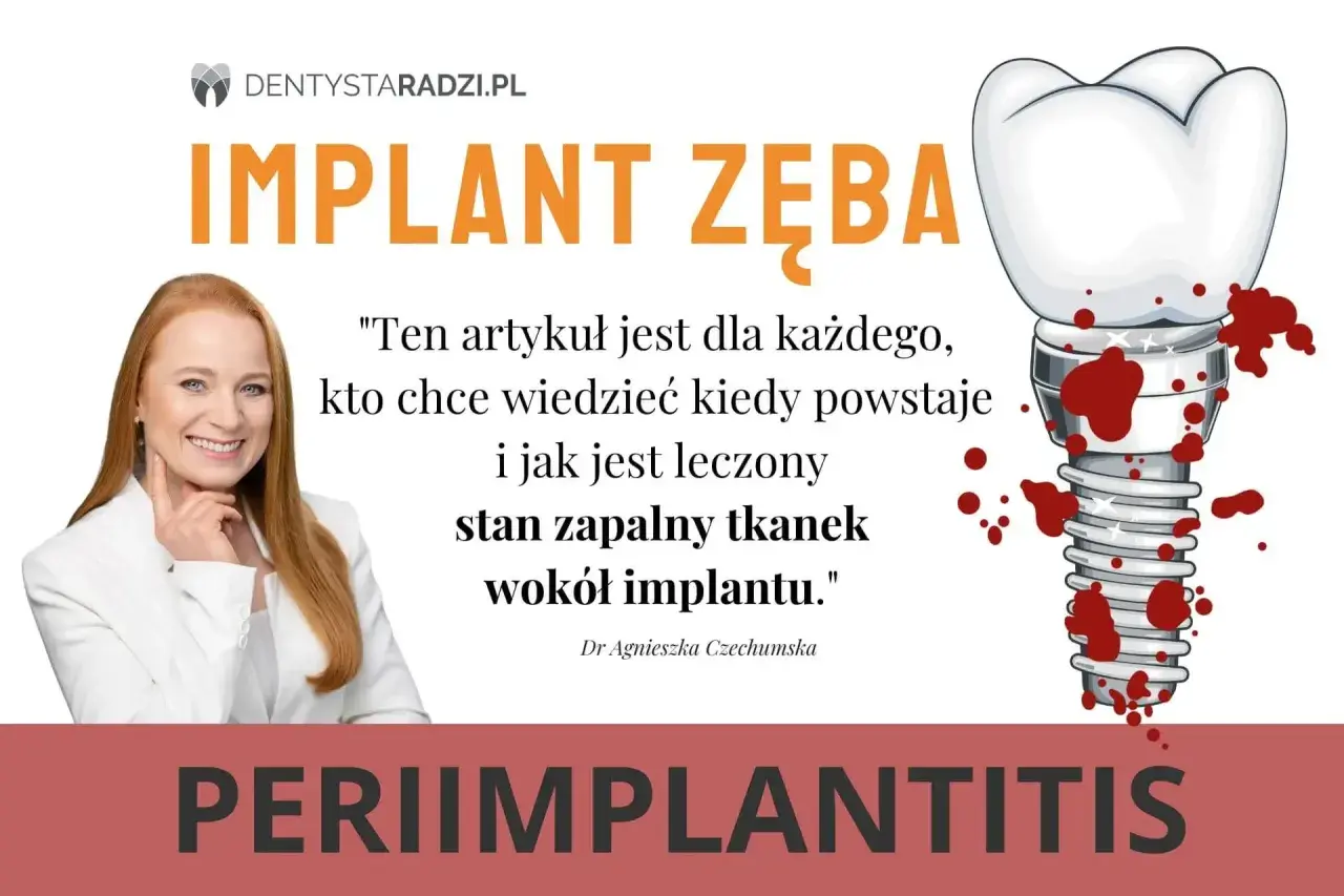 Dowiedz się, jak wyleczyć stan zapalny tkanek wokół implantu zęba. Grafika przedstawia implant zęba z krwią i uśmiechniętą dentystkę.