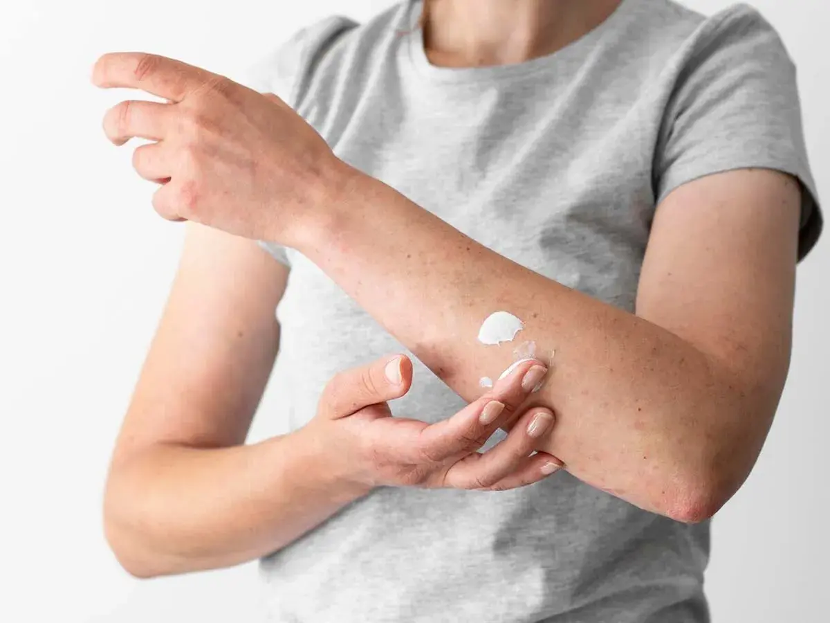 Persona aplica crema en su brazo, quizás para tratar hongos en la piel porque salen por humedad o contacto.