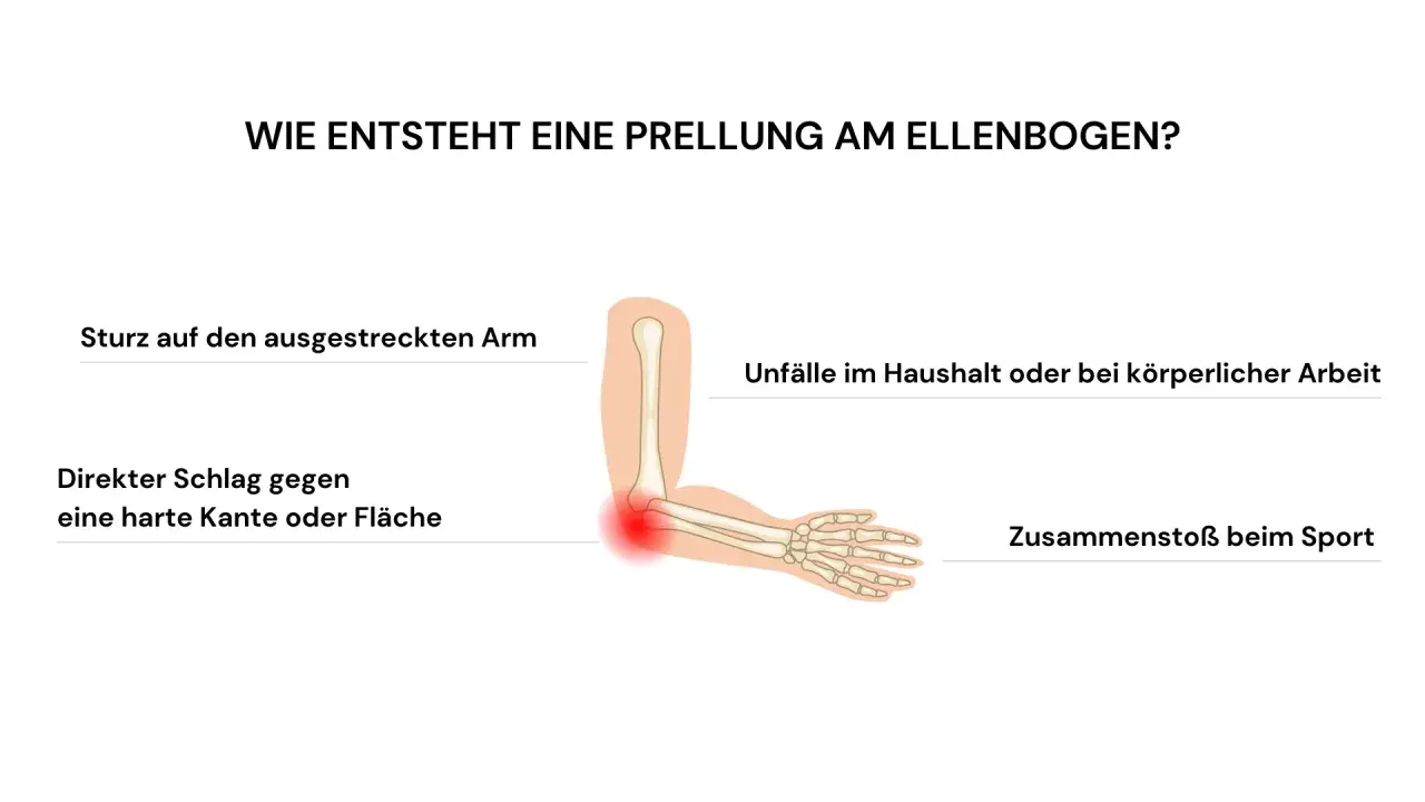 Illustration zeigt, wie **Prellungen nach Sturz** am Ellenbogen entstehen: durch Sturz auf ausgestreckten Arm, Schlag gegen harte Kante, Unfälle oder Sport.