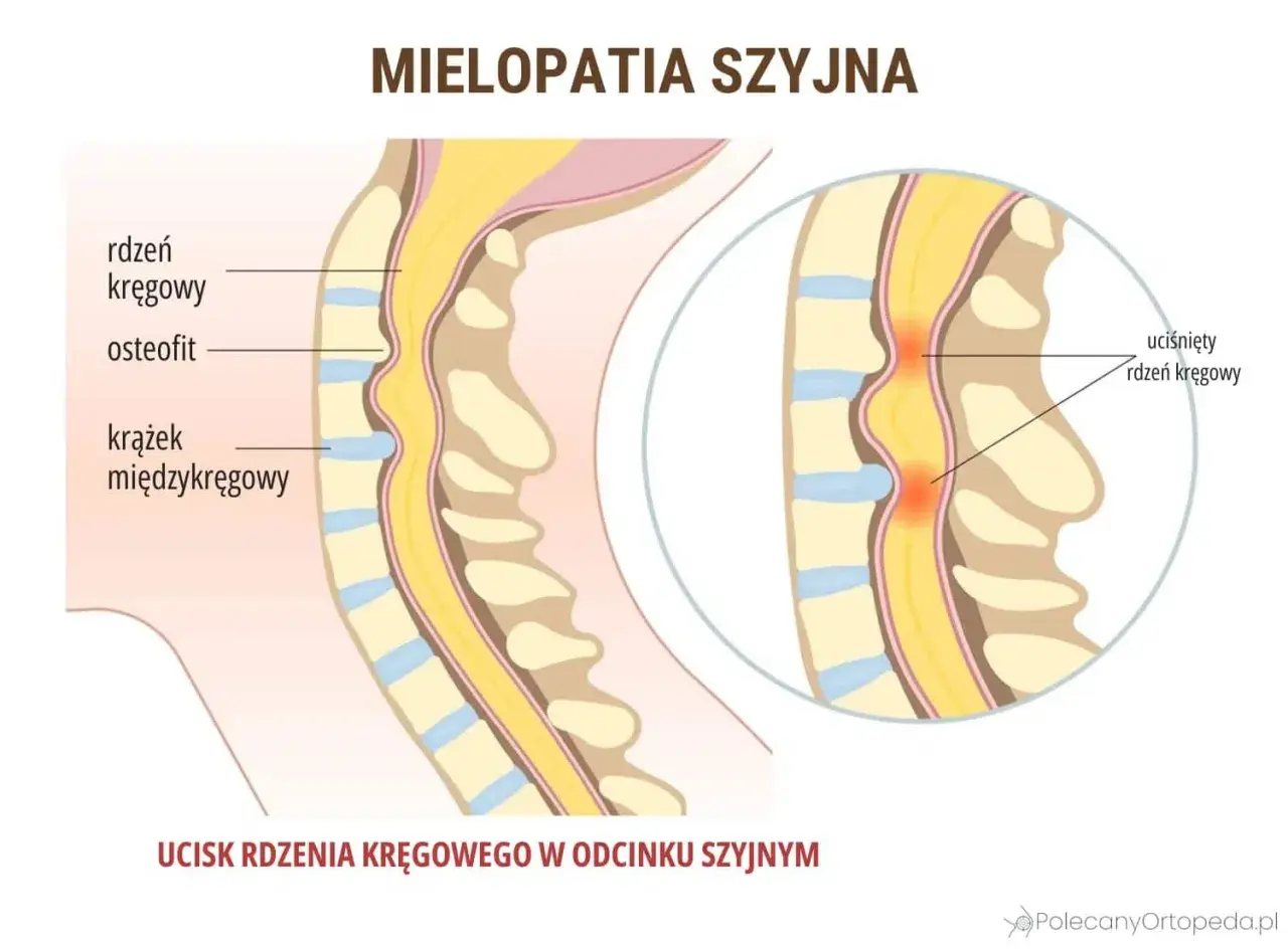 Ucisk na rdzeń kręgowy szyjny objawy: osteofit i krążek międzykręgowy uciskają rdzeń. Mielopatia szyjna.