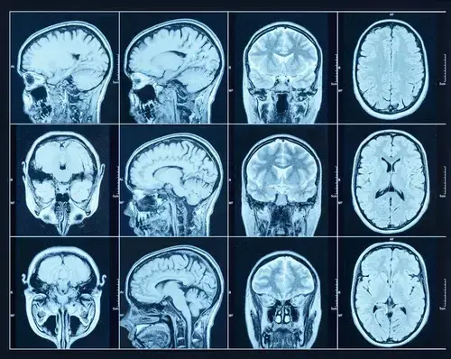 Czy rezonans wykryje choroby psychiczne? Prawda o MRI głowy