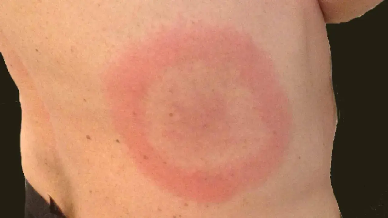 Rött, cirkulärt utslag på huden, liknande en rodnad. Kan vara ett tecken på utslag bebis allergi.