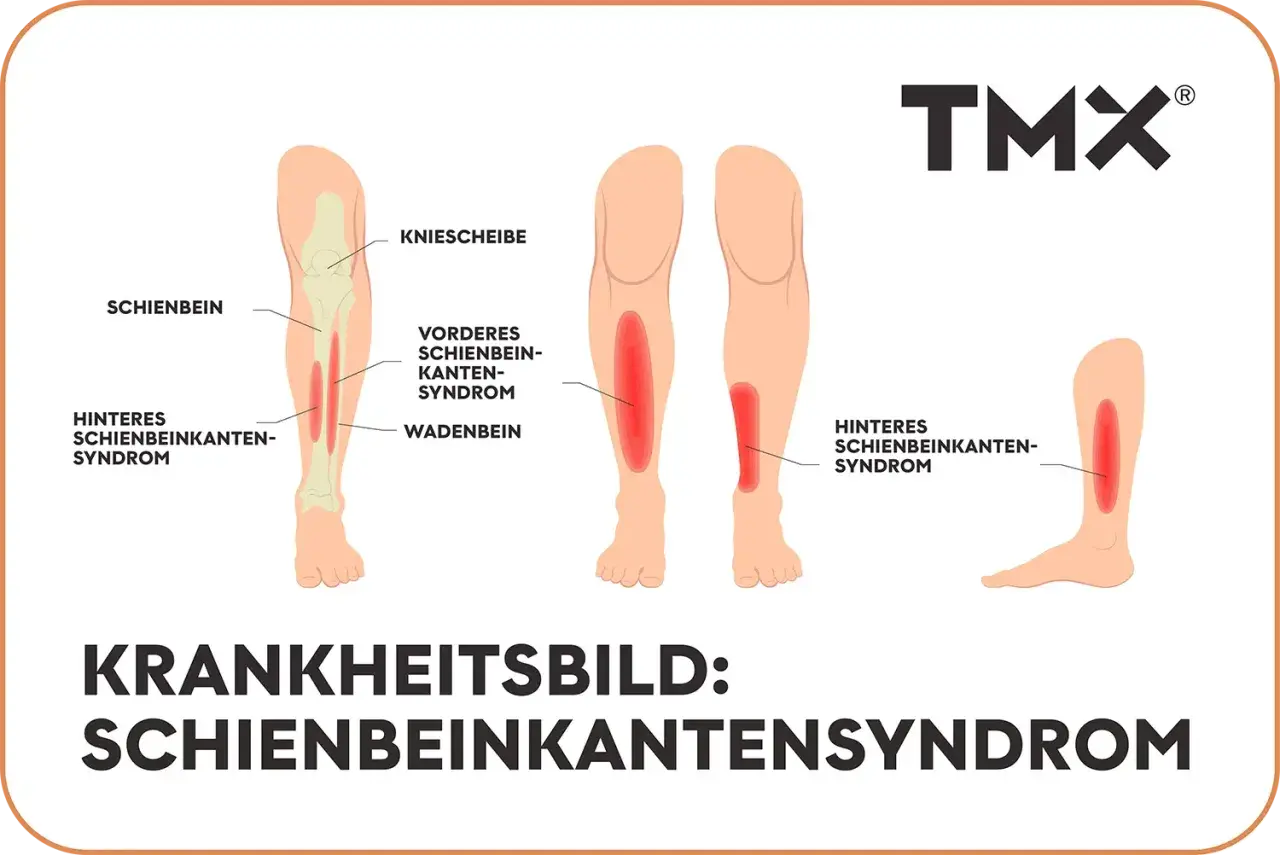 Illustration zeigt das Schienbeinkantensyndrom (shin splint) mit roten Schmerzbereichen am Schienbein und Wadenbein.