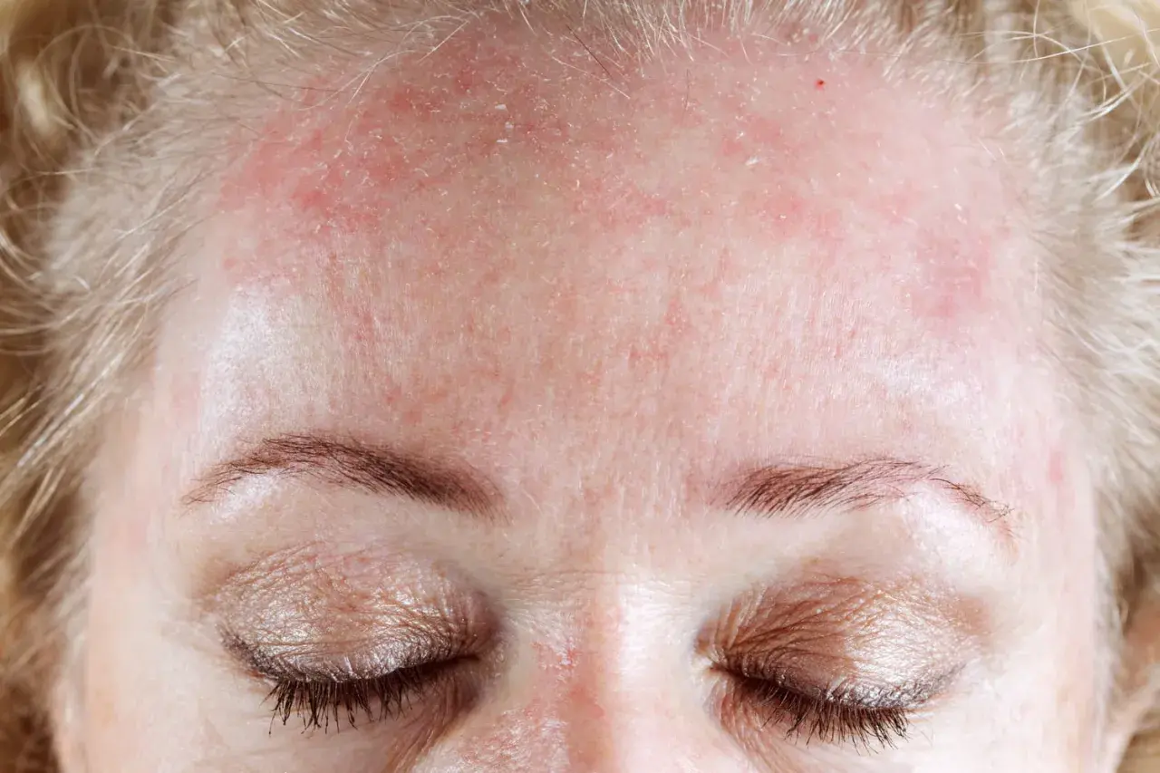 Gros plan sur le front d'une femme aux cheveux blonds, montrant une peau rouge et irritée, avec des zones de **peau qui pèle** près de la racine des cheveux.
