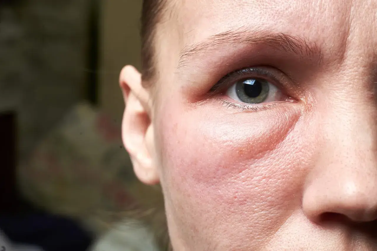 Gros plan sur le visage d'une femme, montrant un œil et une partie de son oreille. La peau sous l'œil est visiblement gonflée, un symptôme courant du visage gonflé pendant les règles.