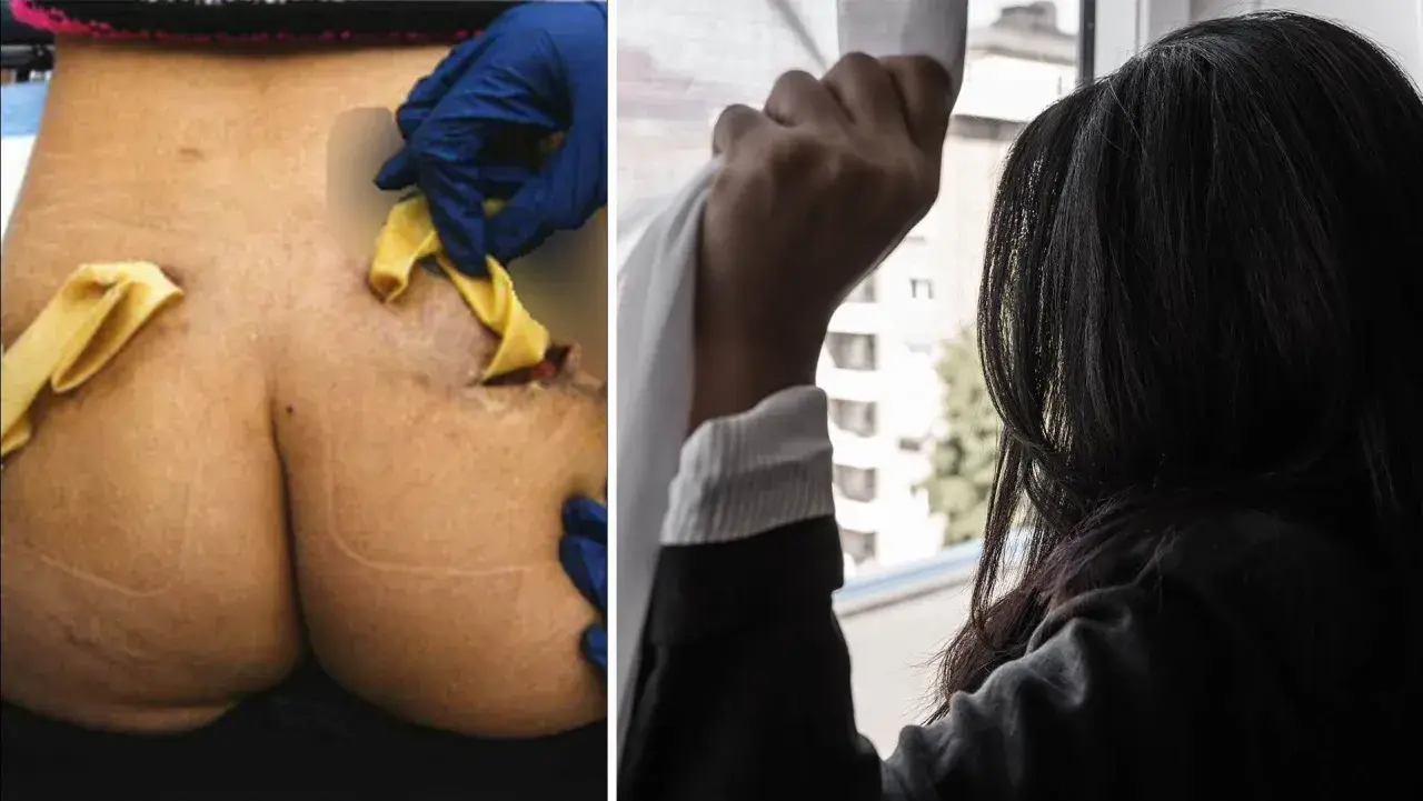 Närbild på en rumpa med synliga ärr och gula kompresser, troligen efter fillers i rumpan. Bredvid en kvinna som tittar ut genom ett fönster.