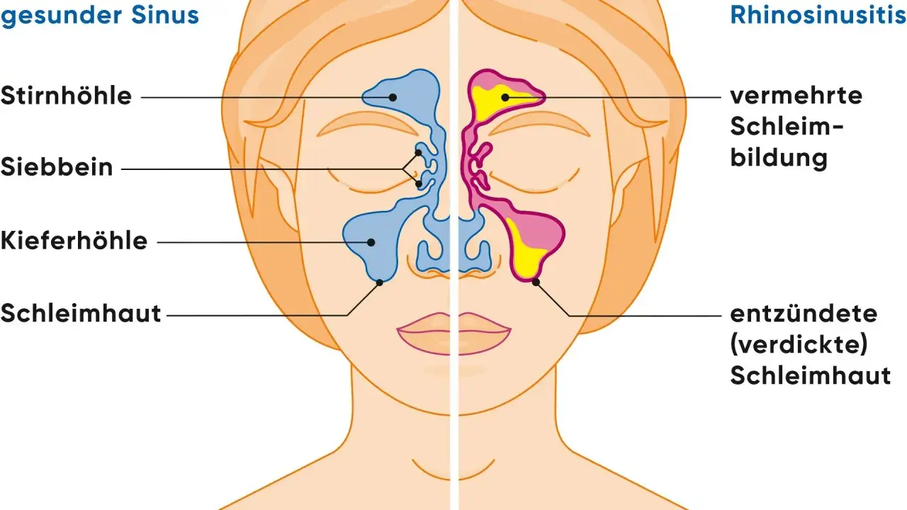 Vergleich gesunder Sinus und Rhinosinusitis: Entzündete Schleimhaut und vermehrte Schleimbildung sind typische nasennebenhöhlenentzündung symptome.