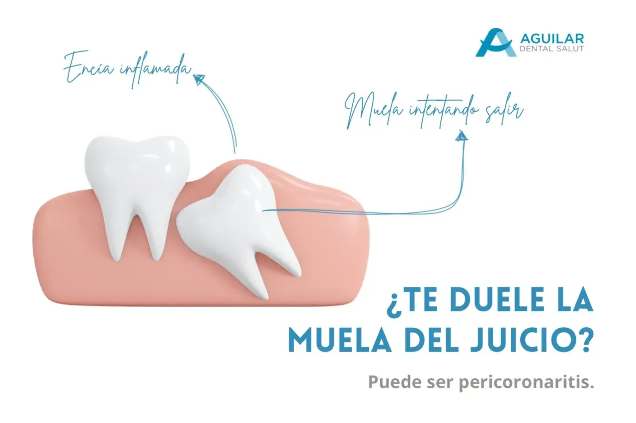Ilustración de una muela del juicio impactada y encía inflamada, causando dolor de cabeza. Pregunta: ¿Te duele la muela del juicio?