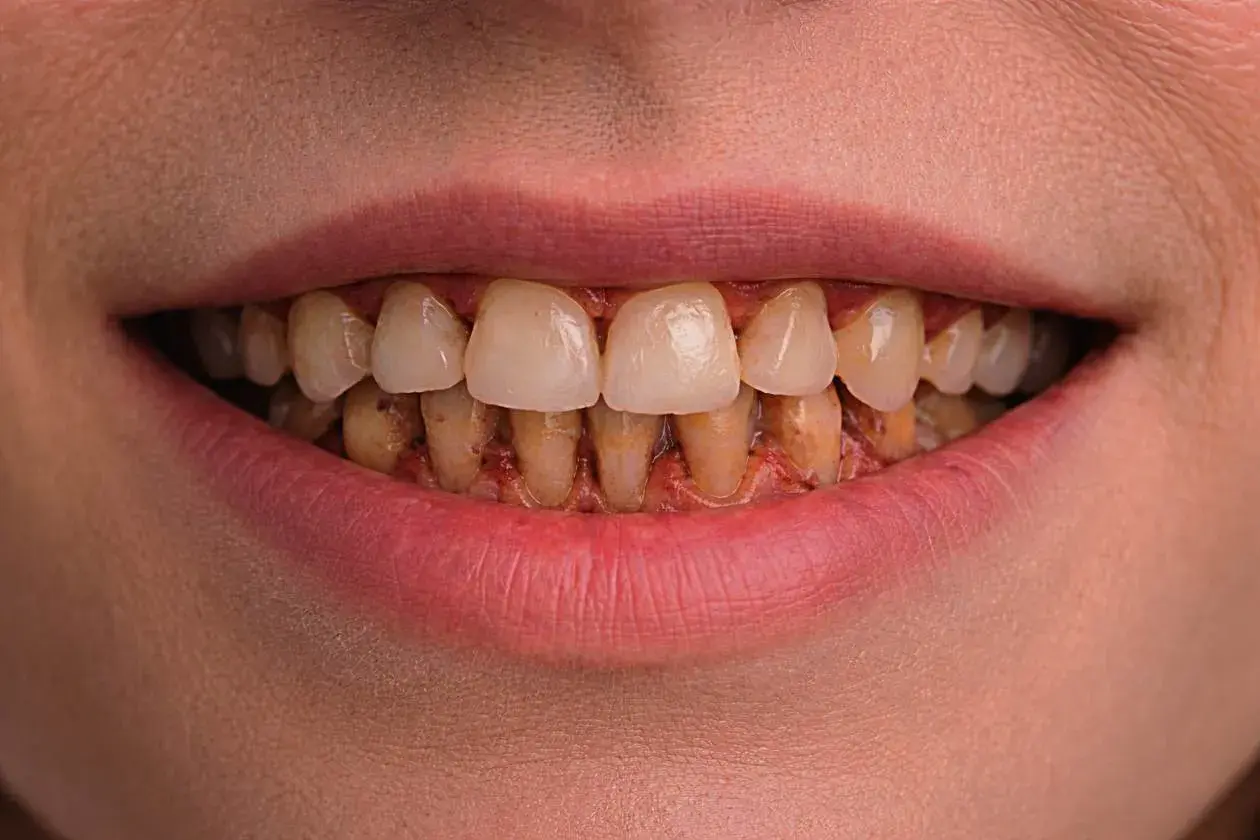 Boca con dientes amarillentos y encías inflamadas, mostrando signos de periodontitis crónica.