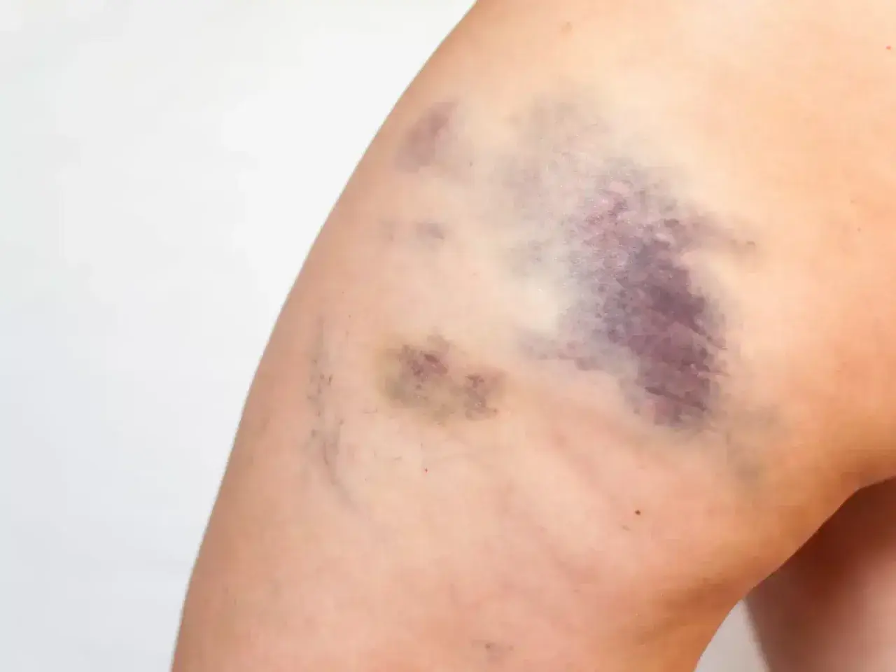 Große, schnell blaue Flecken auf dem Bein einer Frau nach einem Sturz.