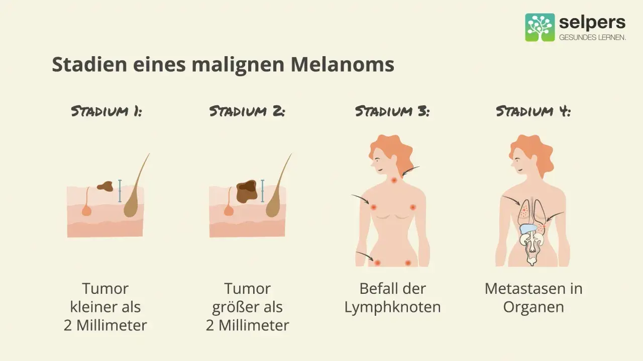 Illustrationen zeigen Stadien eines malignen Melanoms: Tumorgröße, Lymphknotenbefall und Metastasierung. Früherkennung ist wichtig für die schwarzer hautkrebs behandlung.