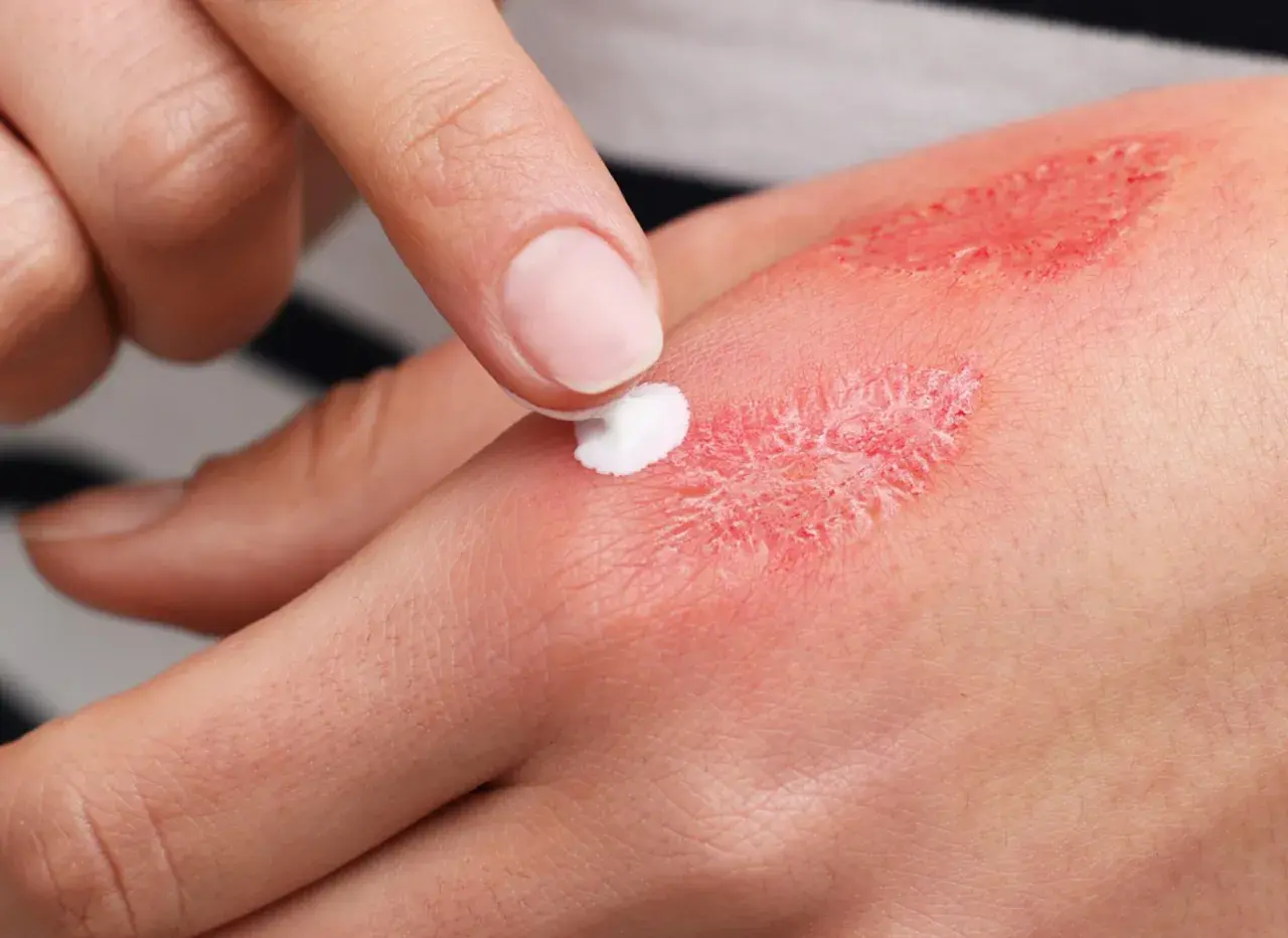 Application de crème sur une brûlure pour favoriser l'étape cicatrisation brûlure. La peau est rouge et irritée.